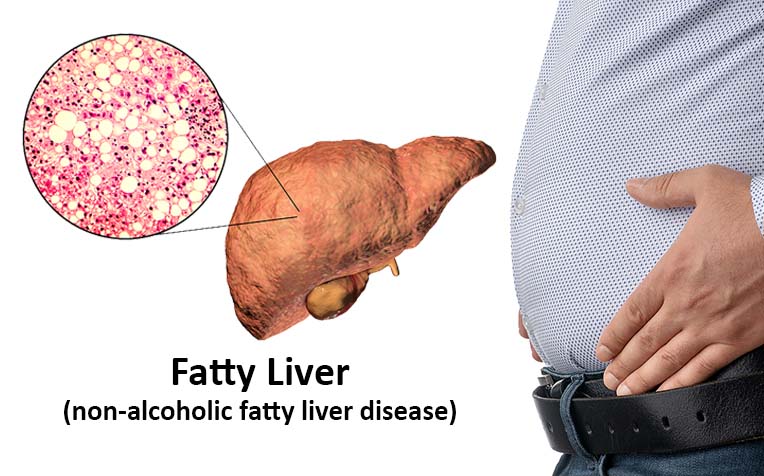 Belly Fat, Uric Acid, Fatigue? It’s Not Your Diet – It’s Your Liver!