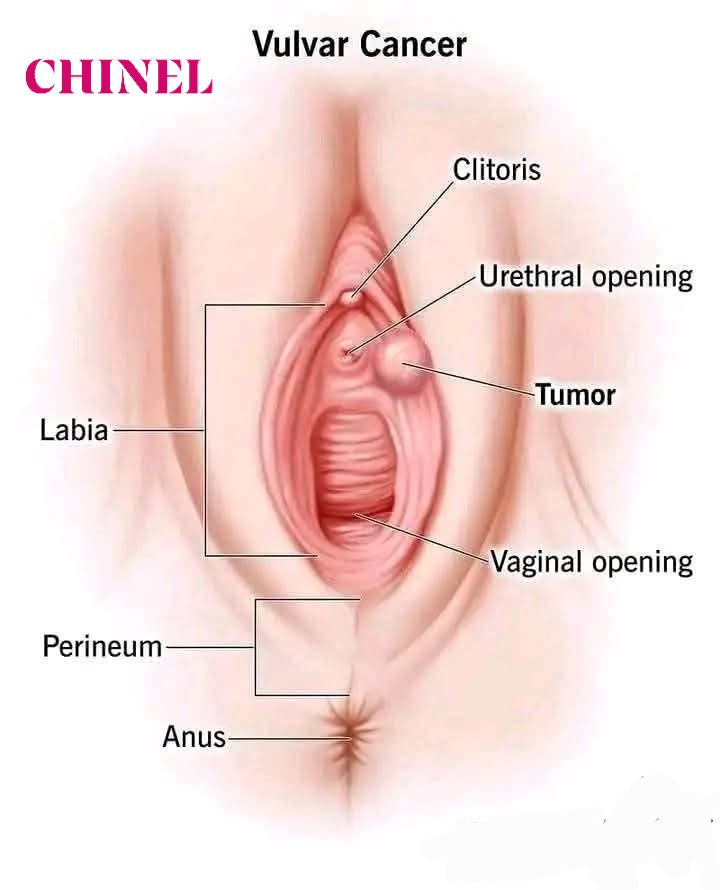 Understanding Vulvar Cancer: Early Detection Could Save Your Life