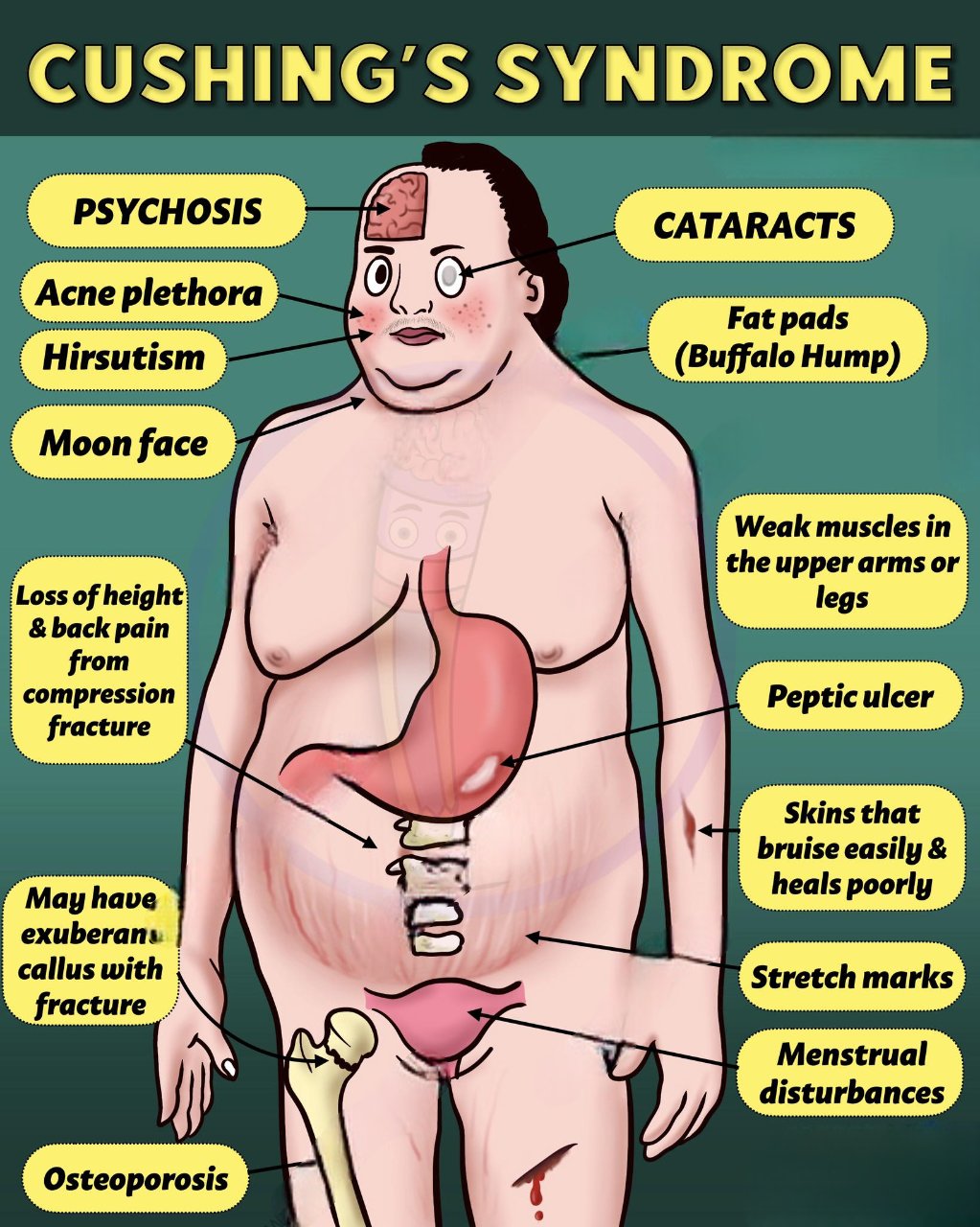 Cushing’s Syndrome: The Hidden Hormonal Imbalance That’s Making You Gain Weight