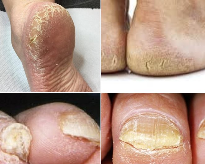 Your Feet: A Window to Your Inner Health